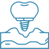 implantes-2